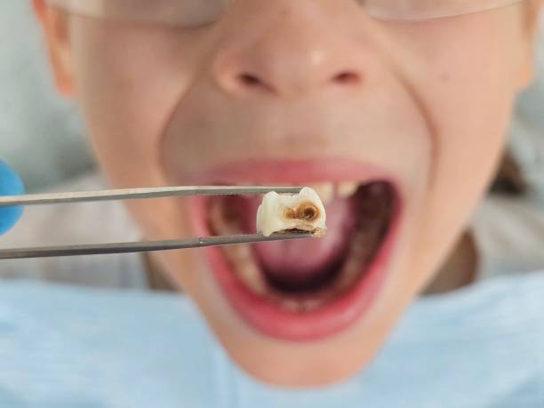 Best Emergency Treatment for Oral Infections in Alanes Ridge, CA