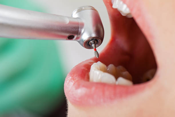 Best Emergency Cosmetic Dentistry (e.g., broken veneers) in Alanes Ridge, CA